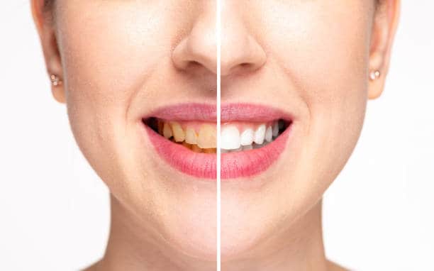 Teeth Whitening Milton Keynes Worthing