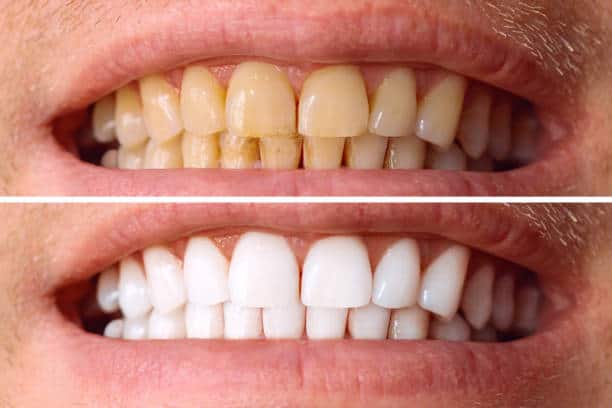 Laser White For Ever Bright – Get a Brighter, Whiter Smile with LA Teeth Whitening Worthing