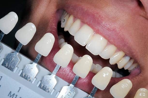 Get Natural and Stunning Smile with Teeth Whitening Results from LA Teeth Whitening Worthing