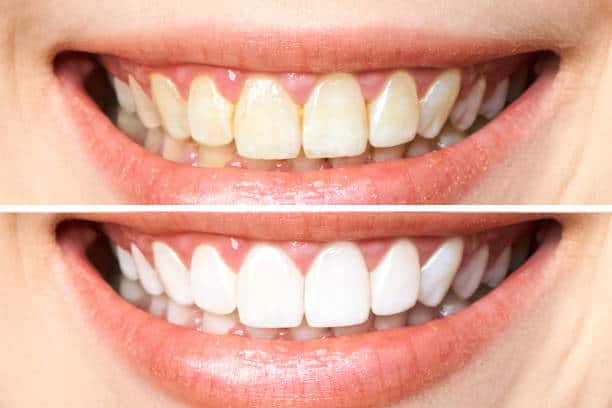 Achieve a Dazzling Smile for Your Special Day: A Guide to Wedding Teeth Whitening Worthing