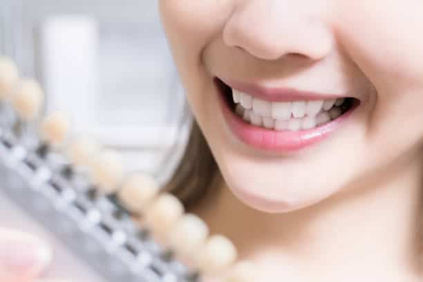 Teeth Whitening Kings Norton Worthing