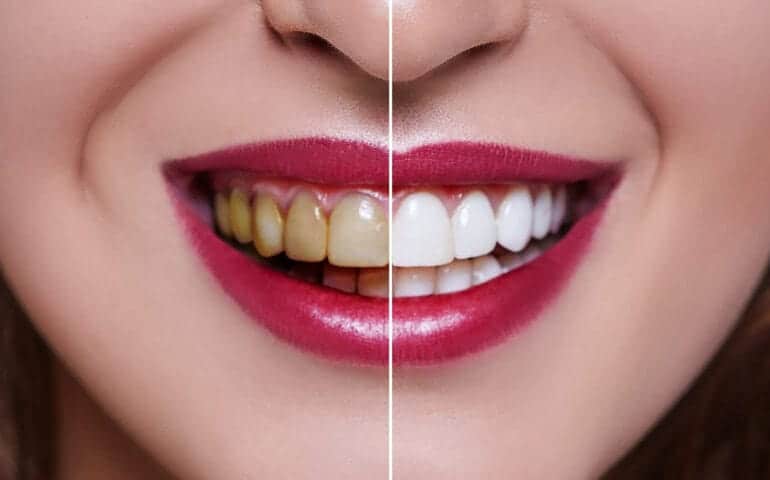 Teeth Whitening Ascot Windsor Worthing