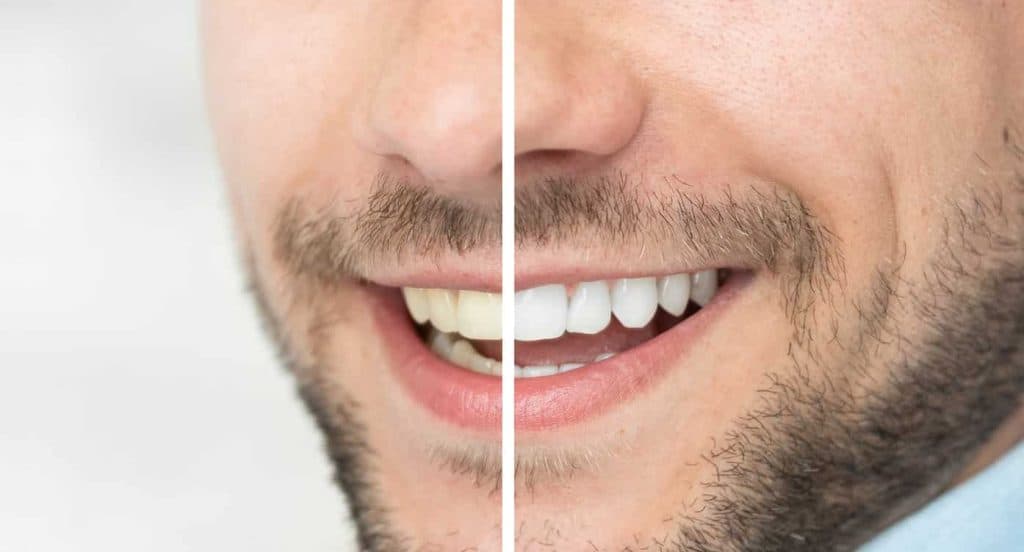 Teeth Whitening Bedfordshire Worthing