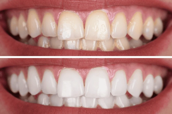 Fast teeth whitening Worthing - whiter teeth in just an hour! Worthing